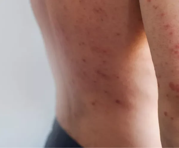 🚨🦠💉 Querétaro confirma cinco casos de sarampión en&hellip;